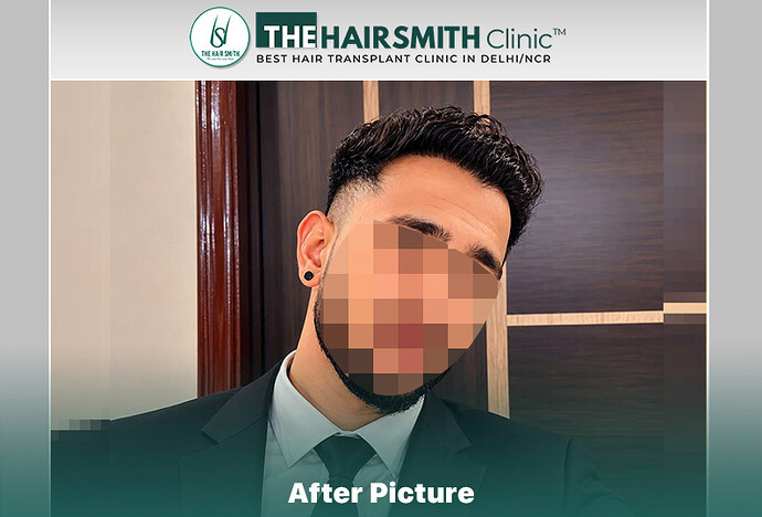 18 months hairsmith hair transplant result - the hairsmith clinic delhi #hairtransplant