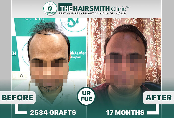 best hair transplant result - the hairsmith clinic
