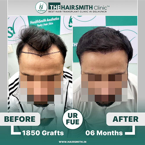 the hairsmith hair transplant result - 06 months update - 2