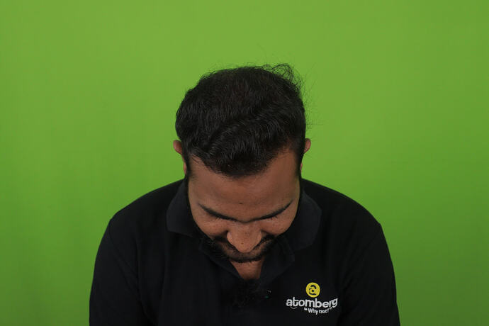 after 6 month hair transplant result