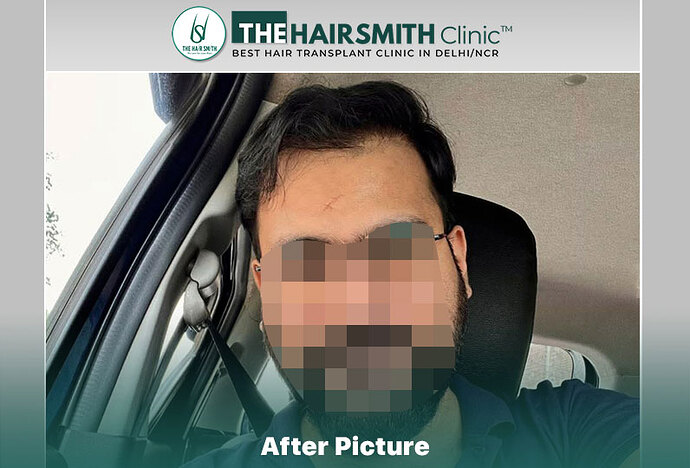 after hair transplant - the hairsmith clinic delhi india #hairtransplant #thehairsmithclinic #urfuehair transplant