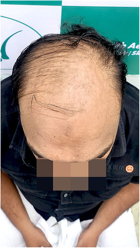 Before Hair Transplant HS 824- The Hairsmith Clinic Delhi India (4)