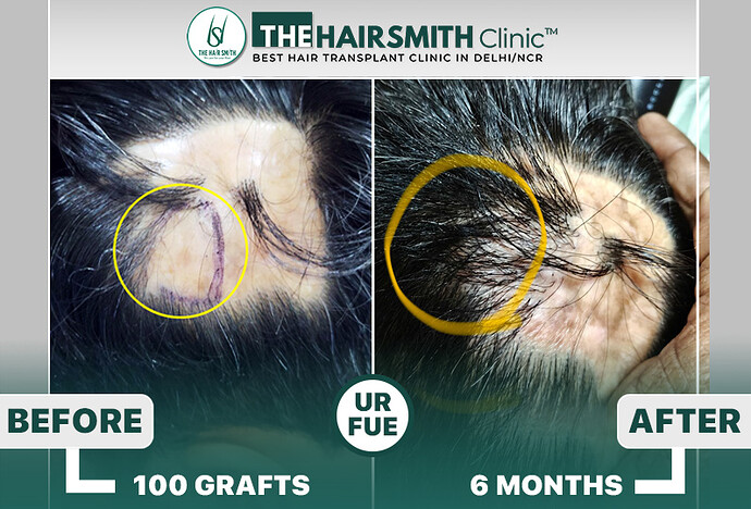 burn scar result - hairsmith hair transplant results