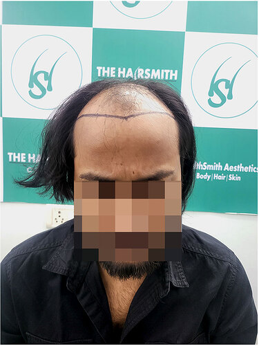 Before Hair Transplant HS 829- The Hairsmith Clinic Delhi India 1