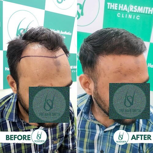 Hairline Hair Transplant Result 2 from The Hairsmith Hair Transplant Clinic