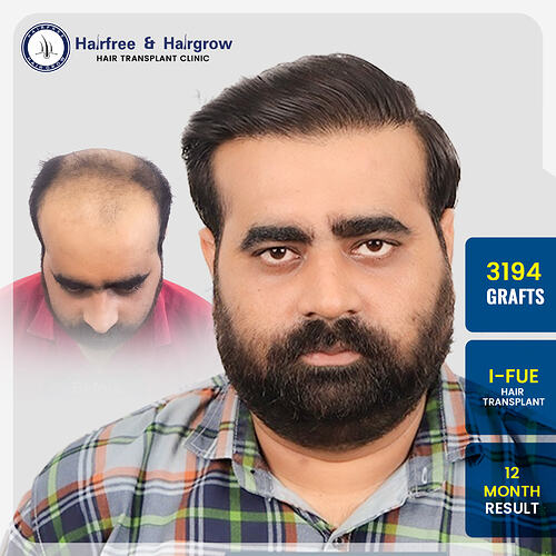 darshan-gohil-hair-transplant-result-3194-grafts-ifue-pune-12-months.jpg