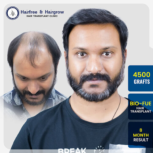 ratul-halder-4500-grafts-bio-fue-hair-transplant-8-month-result-norwood-grade-pune.jpg