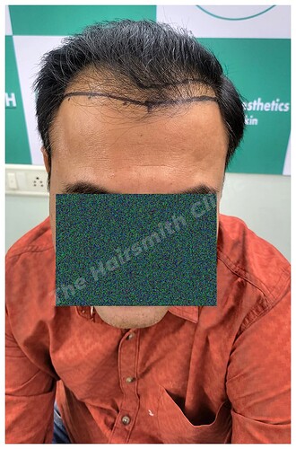 Before Hair Transplant Picture - The Hairsmith Clinic A