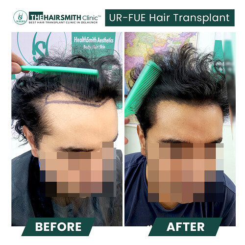 Amazing hair transplant result cp 3 - the hairsmith clinic