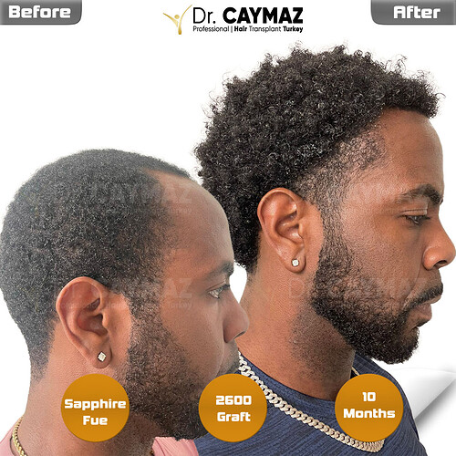 2600-graft-10-months-result-557