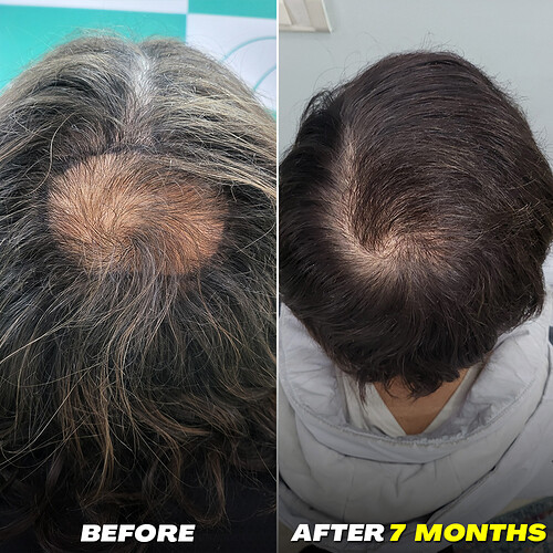 After 7 Months Hair Transplant Result - The Hairsmith Clinic Delhi India - Before After Results - image 1