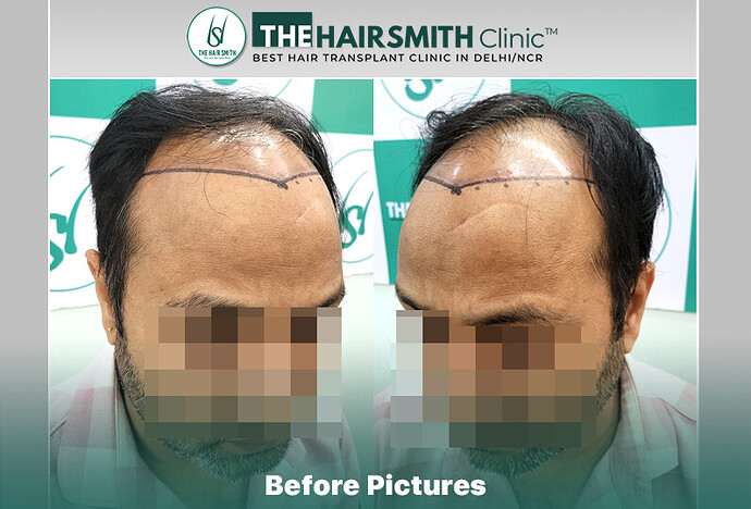 Before Hair Transplant HS 843- The Hairsmith Clinic Delhi India - #hairtransplant #hairregrowth
