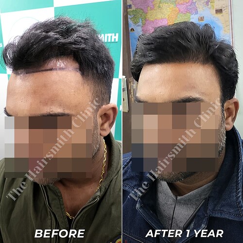 Hairsmith Hair Transplant Result - After 1 year  Update (3)