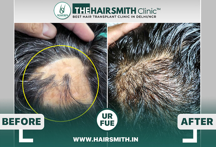 burn scar hair transplant result - the hairsmith clinic - best hair transplant clinic