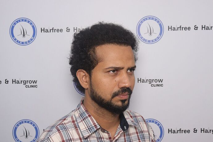 sideviewbeforeafterhairtransplant