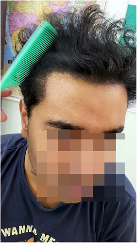 The Hairsmith Hair Transplant Result - After 1 year  Update (4)