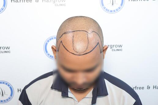 hair line marking