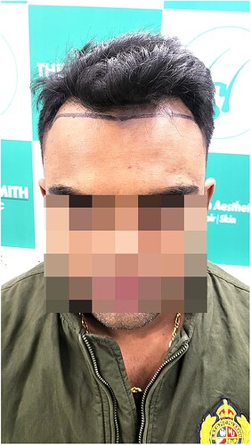 Before Hair Transplant HS 821- The Hairsmith Clinic Delhi India (1)