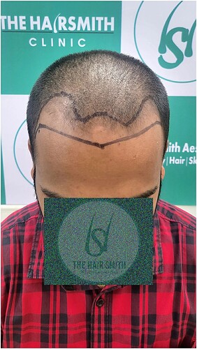 Patient Norwood stages 3 - Before  Picture (2) - The Hairsmith Hair Transplant Clinic