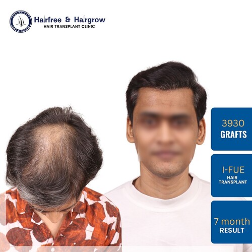 hair-transplant-3930-grafts-7-month-result-pune.jpg (1)