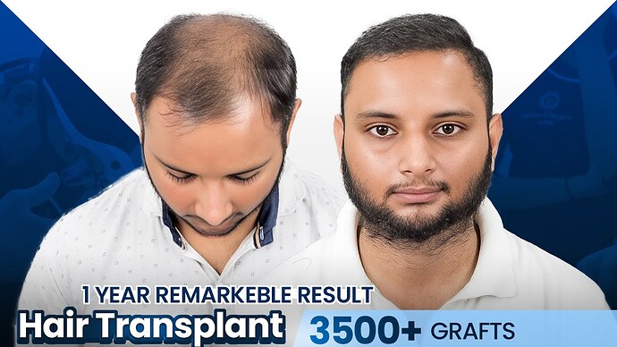 Agam Panwar’s Hair Transplant Journey in Surat