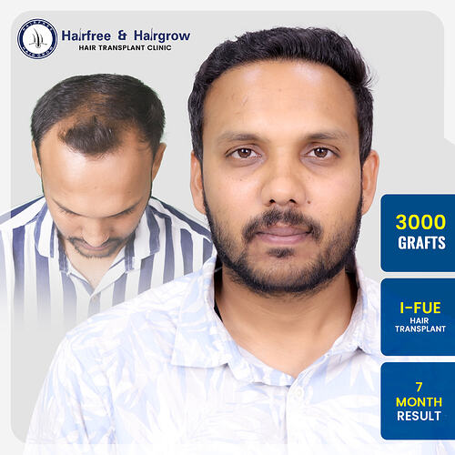 ashutosh-thakur-hair-transplant-result-pune-india-3000-grafts-ifue-7-month.jpg