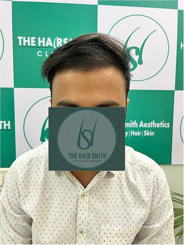 After Hair Transplant Result (1) in India  form The Hairsmith Hair Transplant Clinic