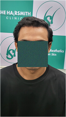 After Hair Transplant Result (1) in India  form The Hairsmith Hair Transplant Clinic
