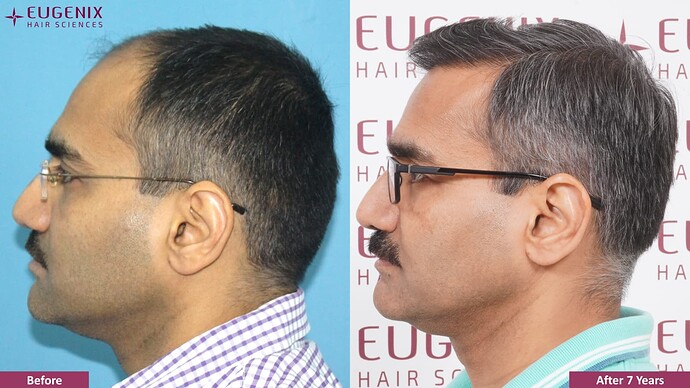 hair-transplant-before-after-3