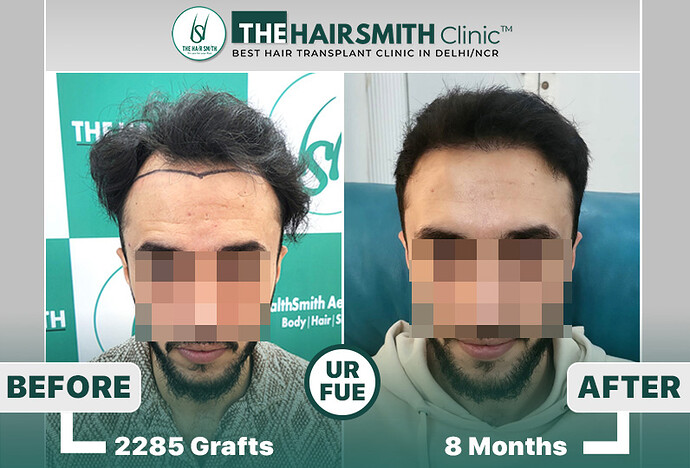 the hairsmith clinic hair transplant result #hairtransplant #hairsmithhairtransplant