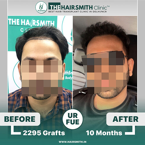 The Hairsmith Hair Transplant Result - before and after -  1