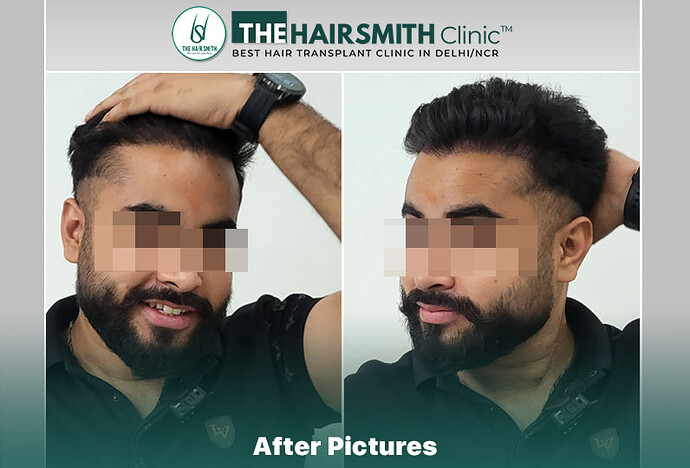 best hair transplant in india - after 9 months result - the hairsmith clinic