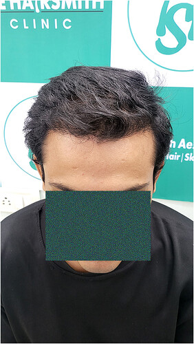 After Hair Transplant Result (2) in India  form The Hairsmith Hair Transplant Clinic