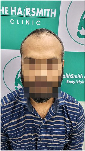 Before Hair Transplant - Norwood Stage 3 - photo 1- The Hairsmith Clinic