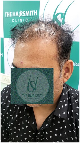 Patient Norwood stages 7 - Before  Picture 5 - The Hairsmith Hair Transplant Clinic