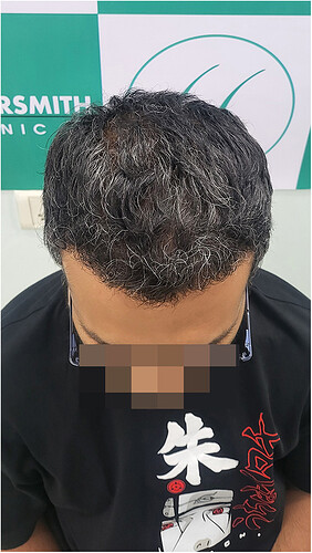 Hair Transplant Result - After 06 Months -  photo 3 - The Hairsmith Clinic