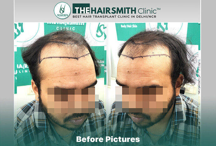 Before Hair Transplant HS 840- The Hairsmith Clinic Delhi India #HairTransplant #URFUEHairTransplant #TheHairsmithClinic