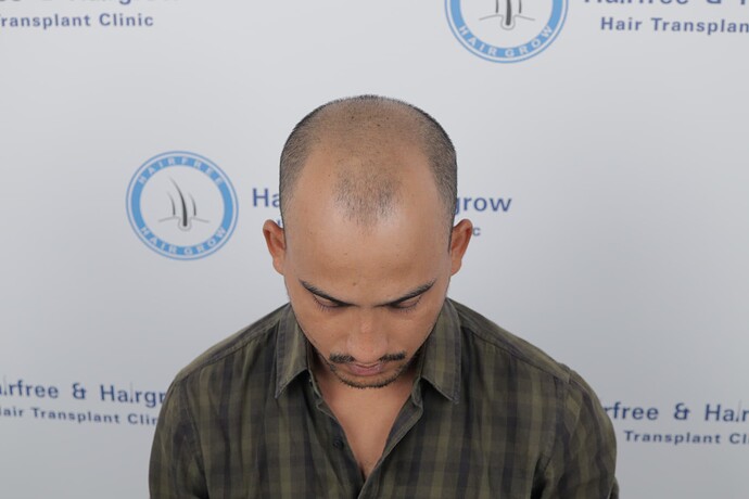 before hair transplant at hair free and hair grow clinic