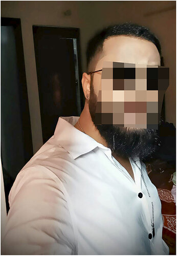 the hairsmith clinic - 11 months hair transplant result update - 1