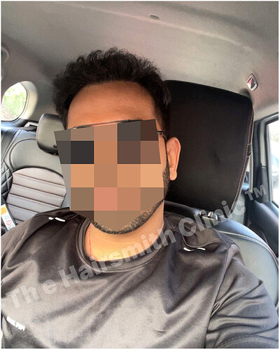 the hairsmith clinic - 10 months hair transplant result