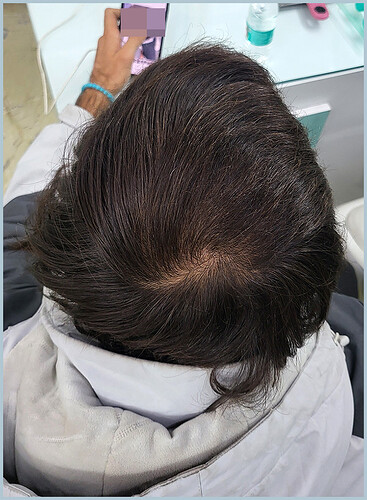 After 7 Months Hair Transplant Result - Best The Hairsmith Clinic Delhi India - Image 1