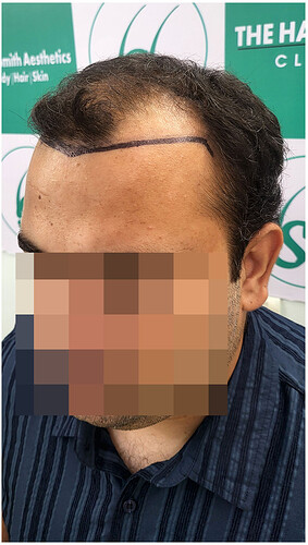 Before Hair Transplant HS 819- The Hairsmith Clinic Delhi India - (3)