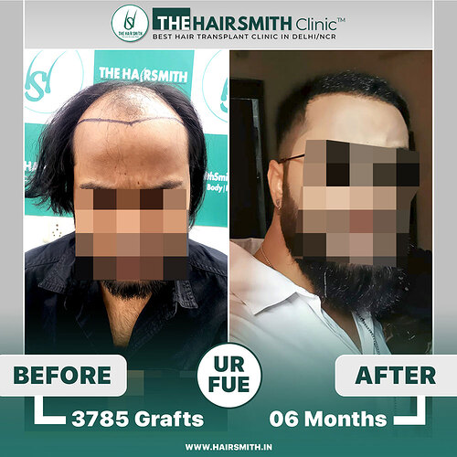 The Hairsmith Clinic Hair Transplant Result - Before and after result 1