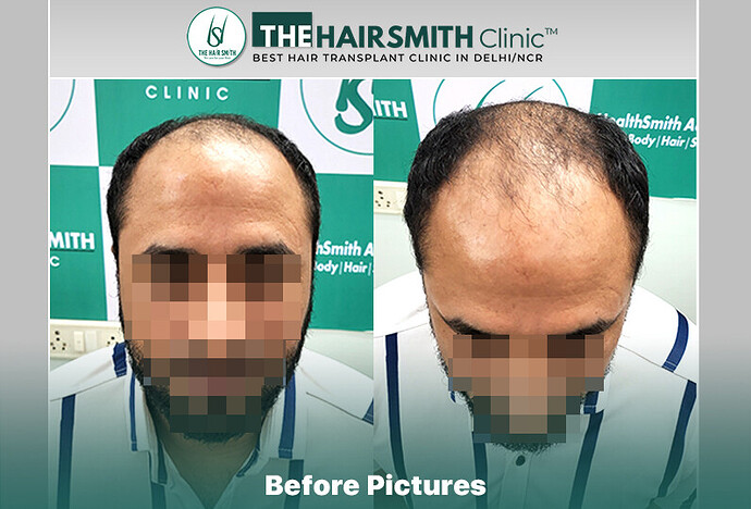 Before Hair Transplant HS 841- The Hairsmith Clinic Delhi India #HairTransplant