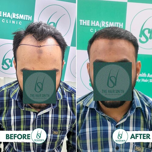 Hairline Hair Transplant Result 1 from The Hairsmith Hair Transplant Clinic