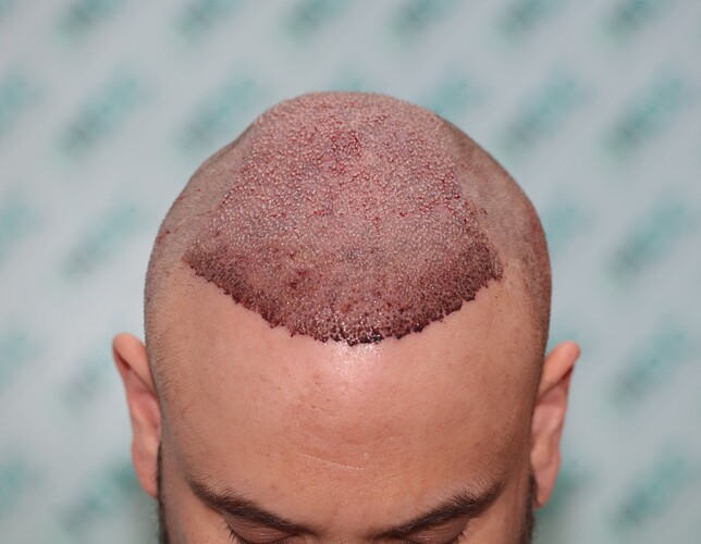 thumbnail_4. post op Front