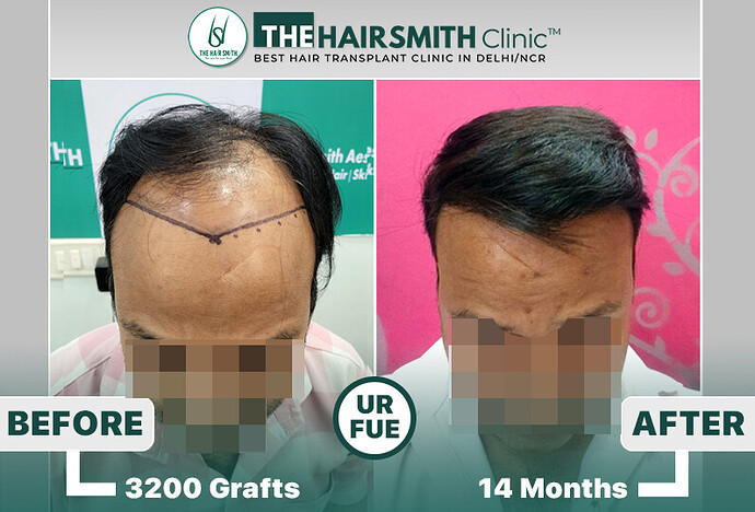 the hairsmith clinic hair transplant result #hairtransplant #hairsmithhairtransplant