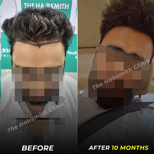 Hair Transplant Result in 10 Months - Before-After - The Hairsmith Clinic 2