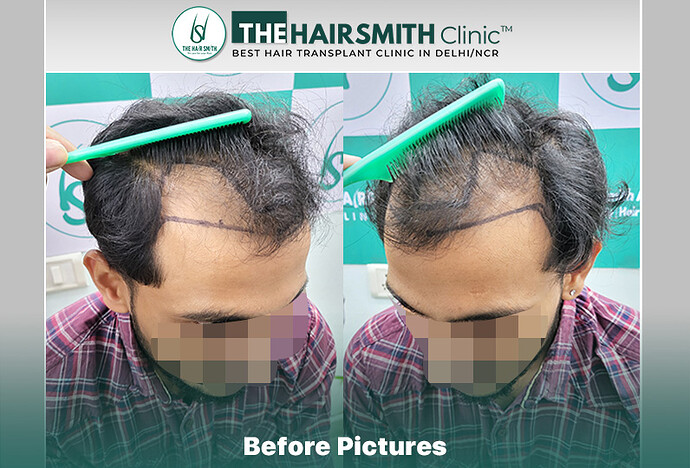 Before Hair Transplant HS 845- The Hairsmith Clinic Delhi India - #hairtransplant #hairregrowth
