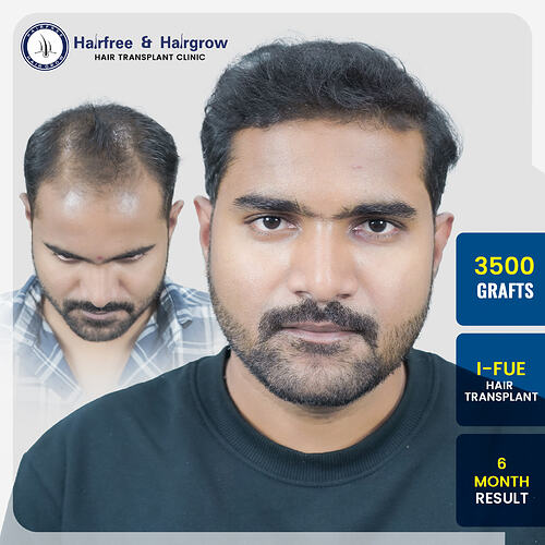 sagar-zujam-3500-grafts-ifue-hair-transplant-6-month-result-pune.jpg